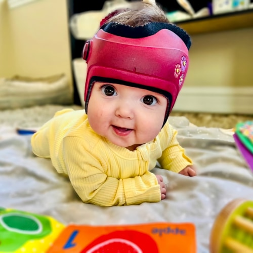 Toddler wearing cranial helmet